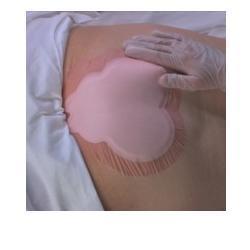 Medicazione idrocellulare adesiva sterile conformata per la regione sacrale assorbente in schiuma di poliuretano allevyn sacrum 22,5x22,1cm 10pz